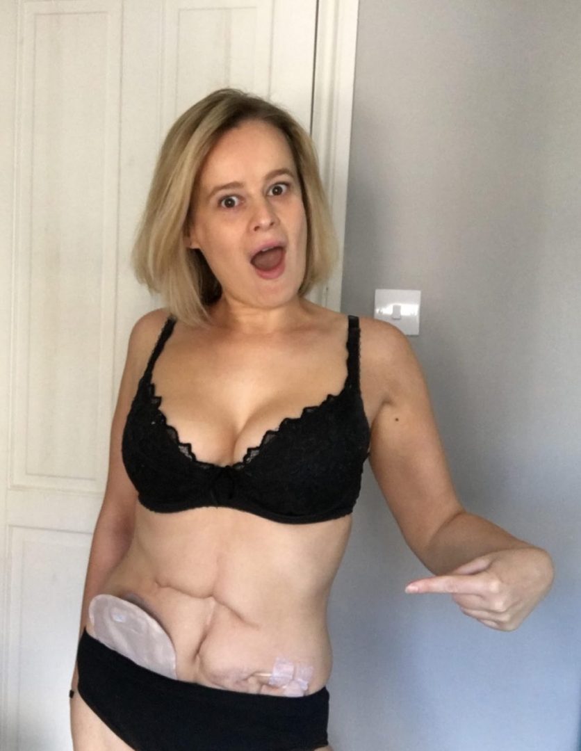 How to be confident with a disability? Photo of Kate Jennings for article on 'Sexy Disabled Body' Kate is standing in front of a mirror taking a selfie of her self. She is bearing her scarred stomach with a stoma bag.